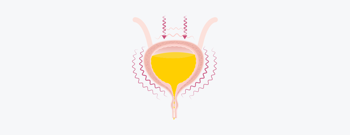 Grafische Darstellung zum körperlichen Mechanismus bei der Mischinkontinenz